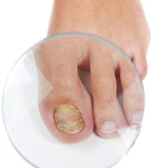 Fungo das uñas