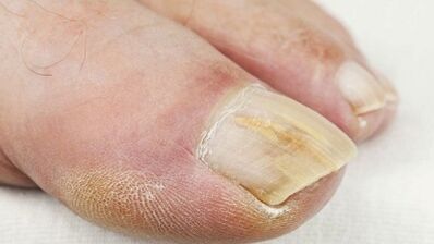 A fase inicial do desenvolvemento do cogomelo nas uñas