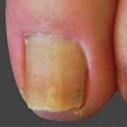 Infección das unhas causada por dermatofitos