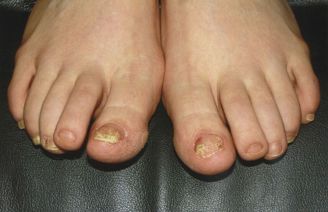 Como tratar o fungo das unhas dos pés con esmalte