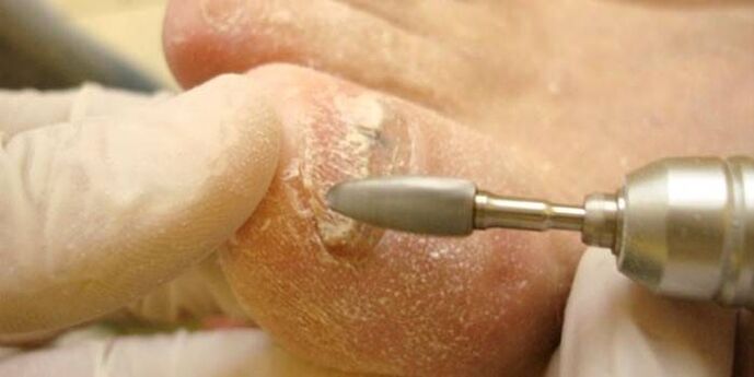Eliminación de fungos nas unhas