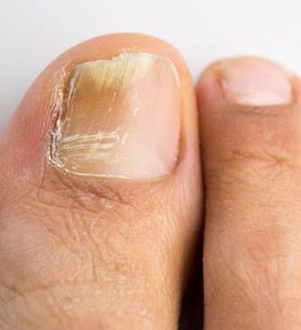 Fungo das unhas no dedo gordo do pé, que ocorre no contexto dunha inmunidade débil