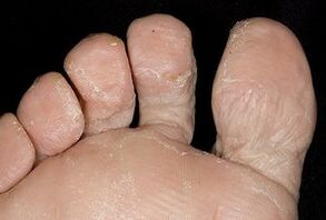 A pel dos pés cunha infección fúngica