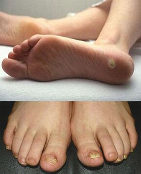 Manifestacións de micose na pel e unhas dos pés