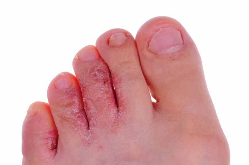 Os síntomas da rubrofitose son gretas e escamas na pel das pernas
