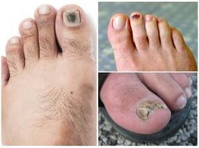 Sinais dunha infección fúngica na unha do pé
