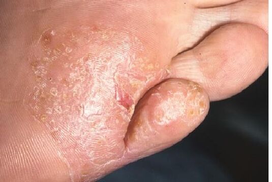Manifestacións de infección fúngica da pel dos pés
