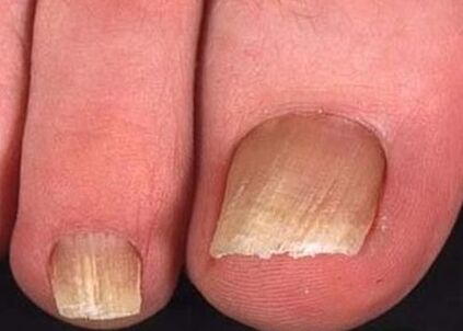 Fungo das uñas nas pernas do nivel inicial