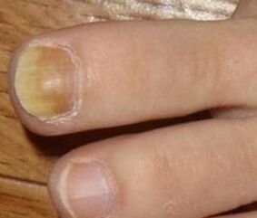 Síntomas da etapa inicial do fungo das uñas